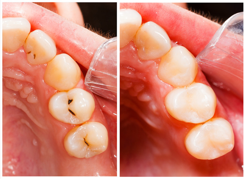 Fillings North Bergen, NJ