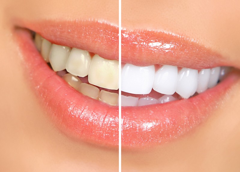 Teeth Whitening North Bergen, NJ