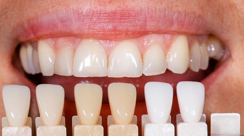 Veneers North Bergen, NJ