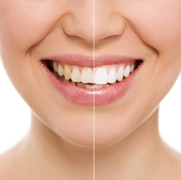 Before and after teeth bleaching or whitening treatment.