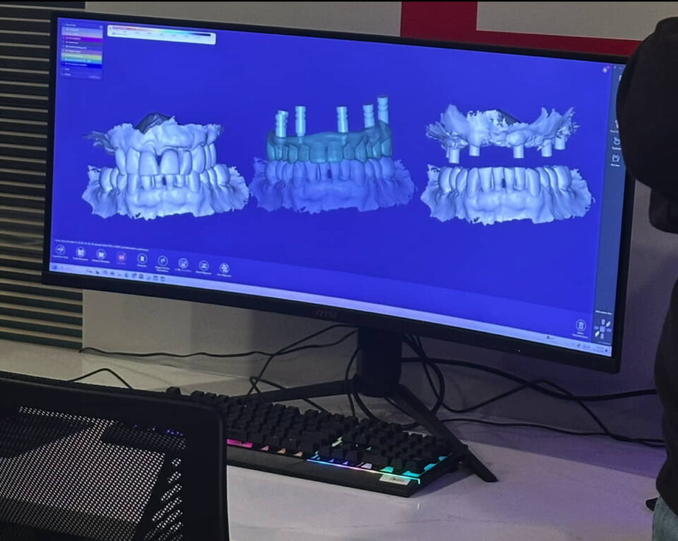 Image of photogrammetry work to create Overdentures at Aesthetic Dental in North Bergen, New Jersey