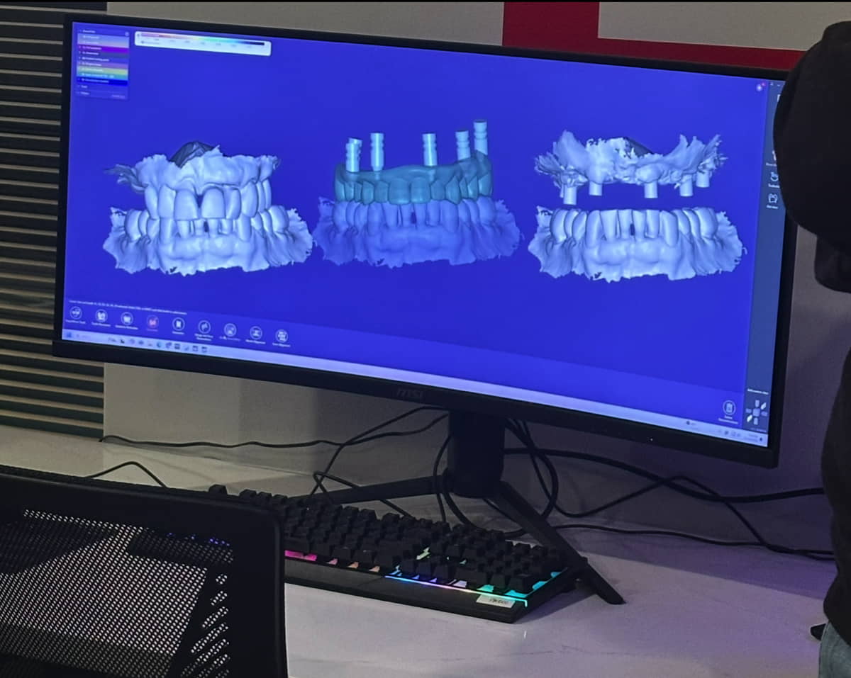 Image of photogrammetry work to create Overdentures at Aesthetic Dental in North Bergen, New Jersey