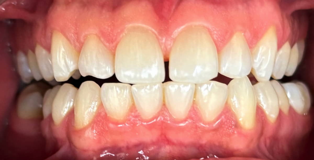 Before Zoom teeth whitening results for a brighter smile