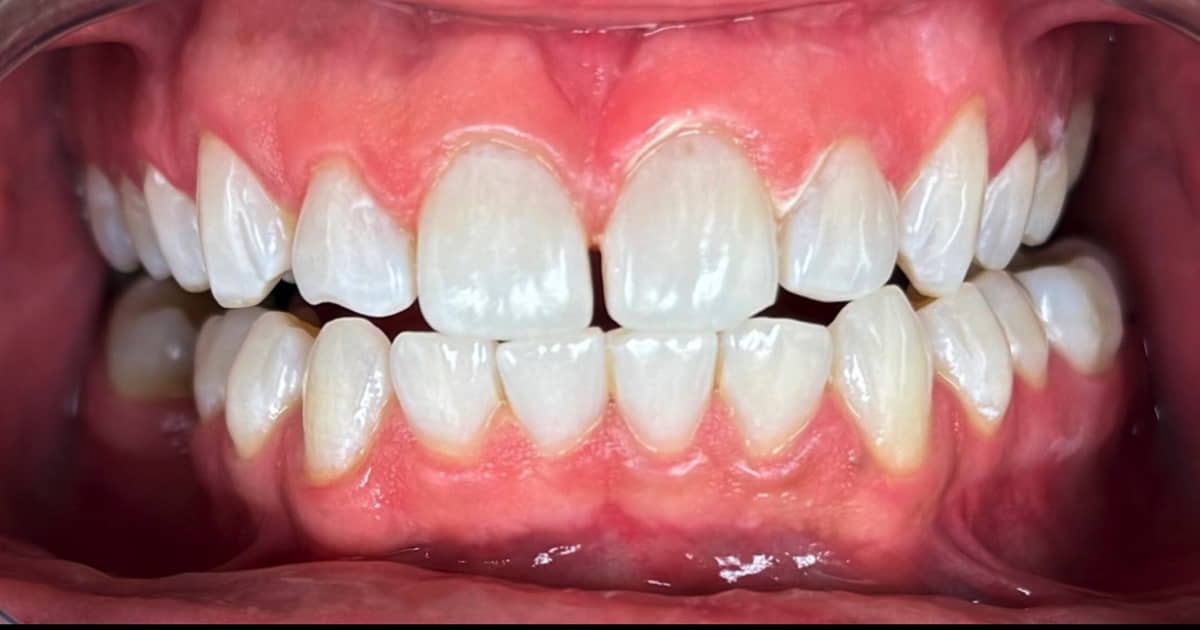 After Zoom teeth whitening results for a brighter smile(1)-resized