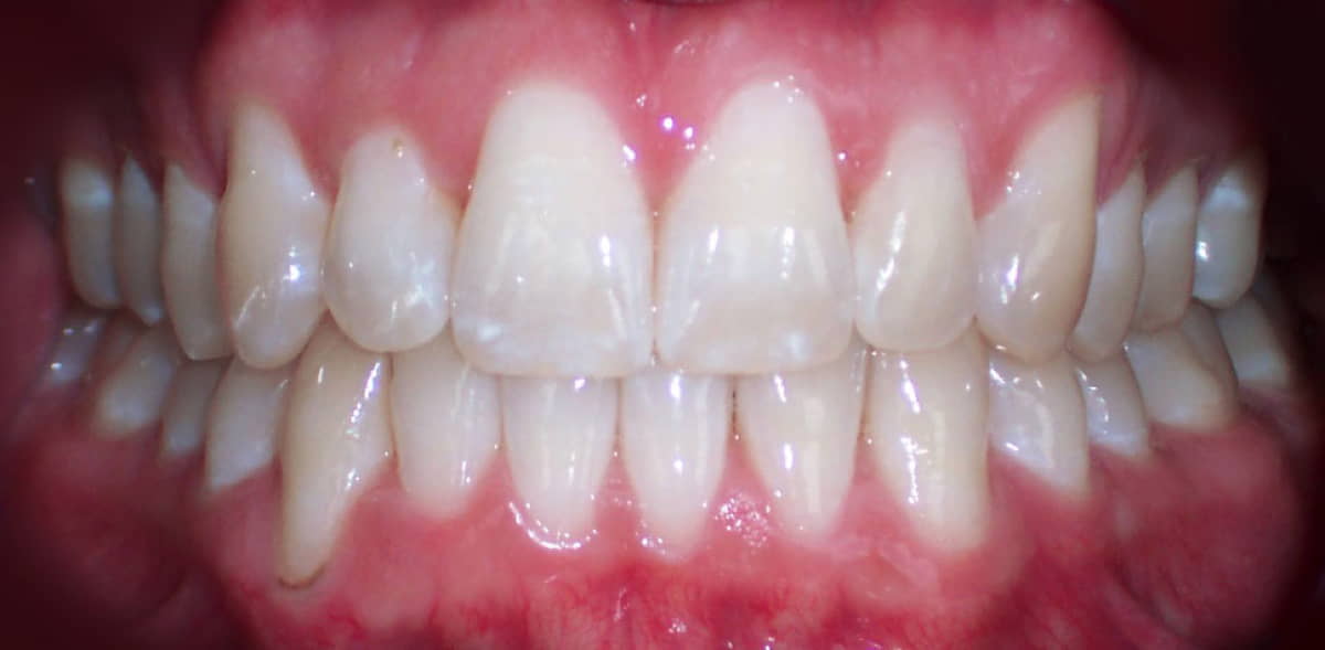 Invisalign clear aligners before and after results for teeth straightening