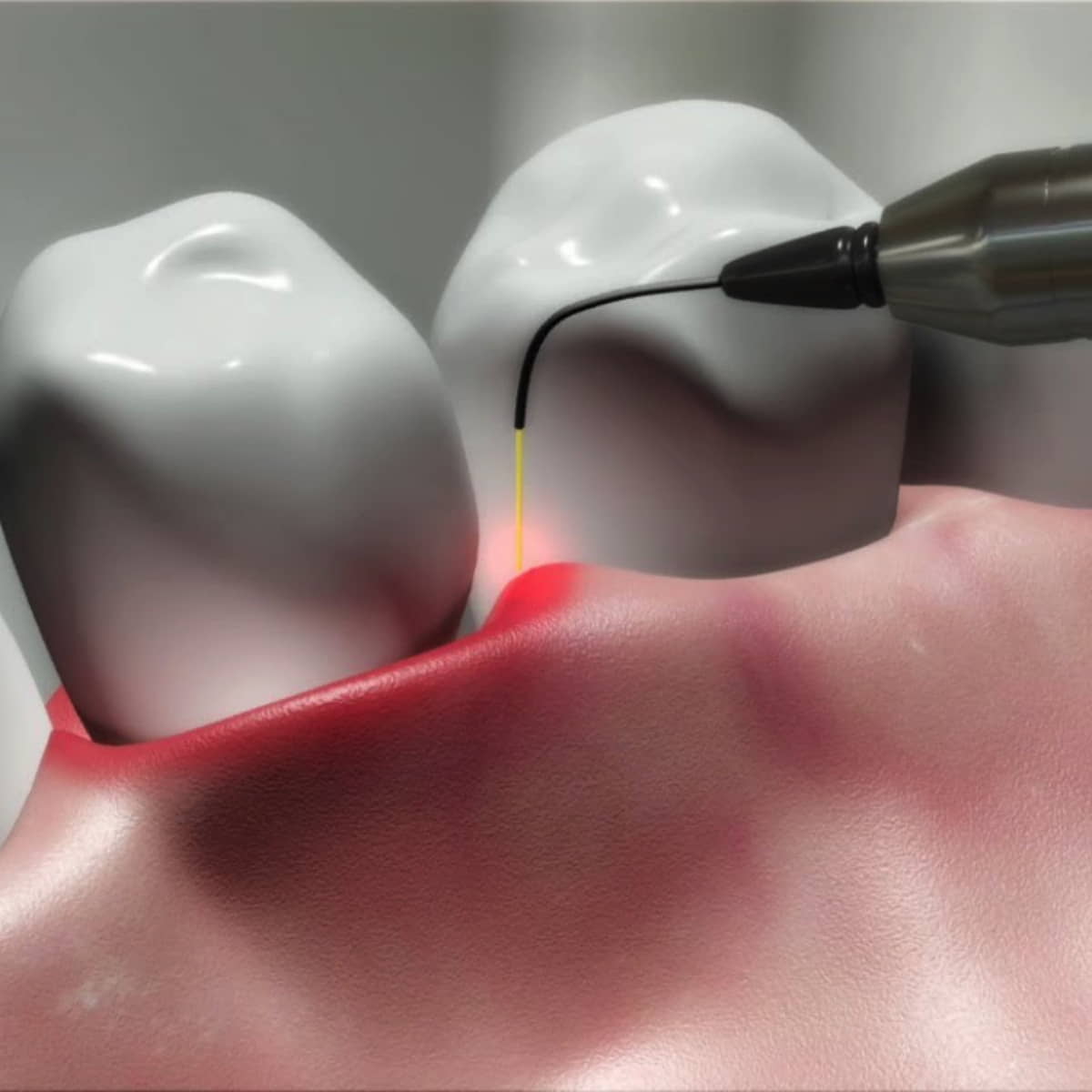 Lanap Therapy for gum disease and bone loss. Remove infection without cutting tissue_