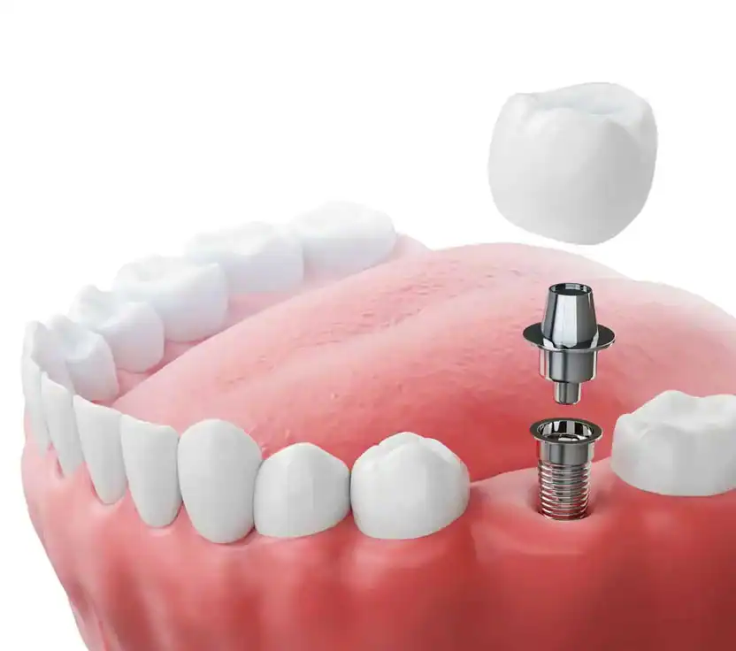 Dental implant procedure illustration, Aesthetic Dental