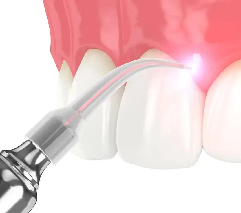 Laser gum therapy treatment at Aesthetic Dental