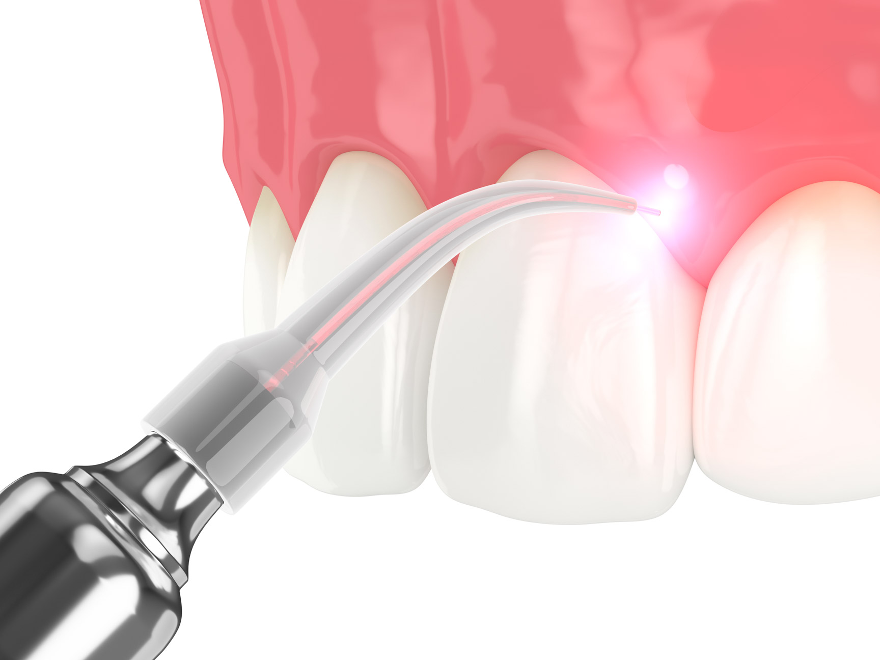 Laser dental treatment illustration